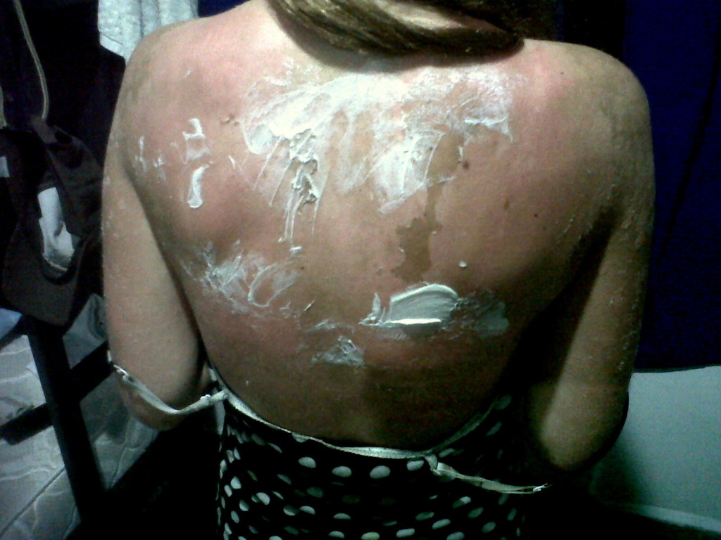 sunburn Galapagos