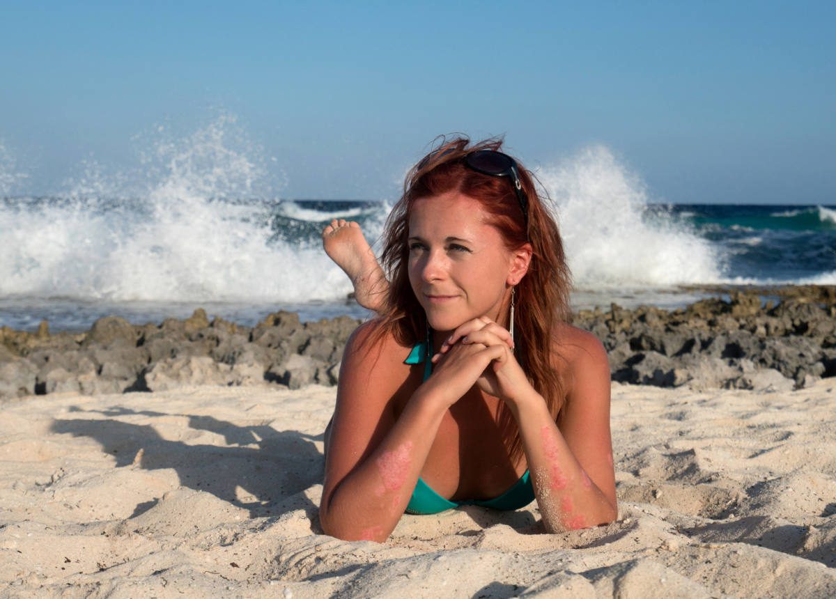 Wearing a bikini at the beach shows the psoriasis patches on arms.